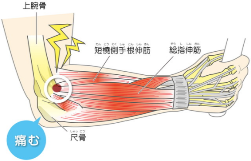 テニス肘1